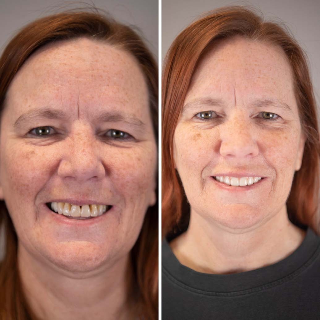 woman's smile before and after